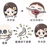 改臉型手術效果如何？